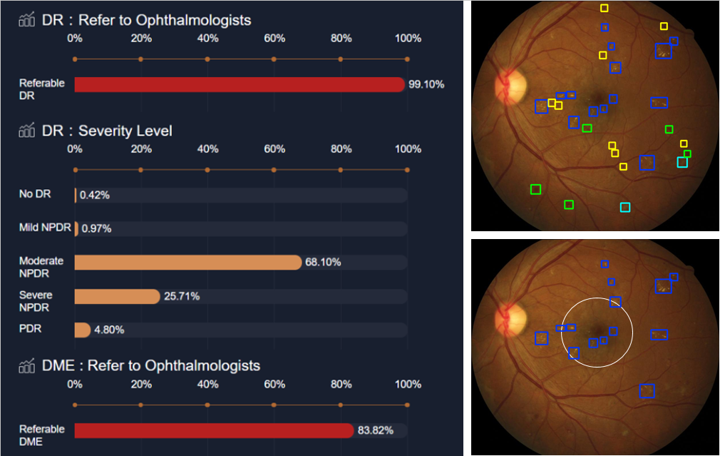 Figure 2. AI Decision Support Technology of Fundus Image in Diabetes Mellitus